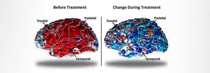 Ketamine Therapy Effects On The Brain